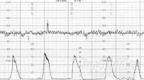 Что такое КТГ при беременности?