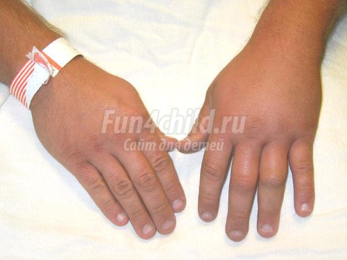 Опух укус осы