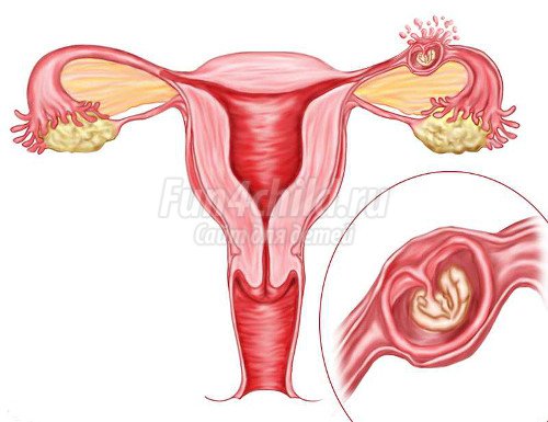 Что значит внематочная беременность