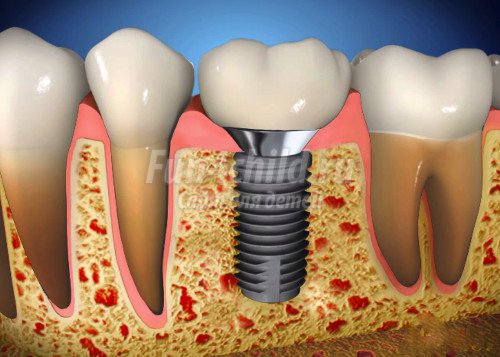 Зубной имплантат