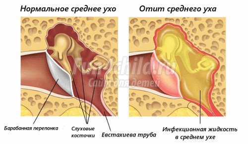 Отит среднего уха