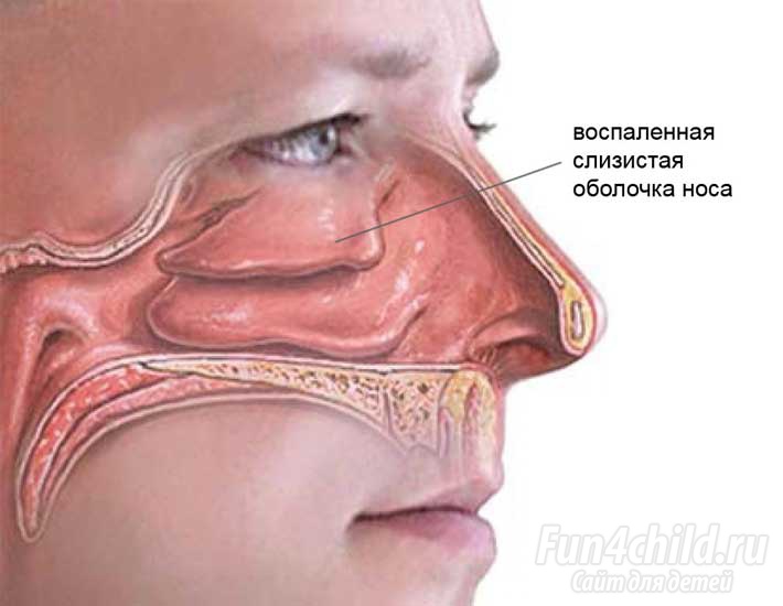 Воспаленная слизистая носа