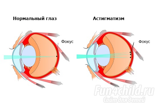 Что такое астигматизм